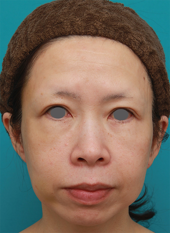 イタリアンリフトで頬のたるみをリフトアップした50代女性の症例写真の術前術後画像,Before,ba_italian21_b.jpg