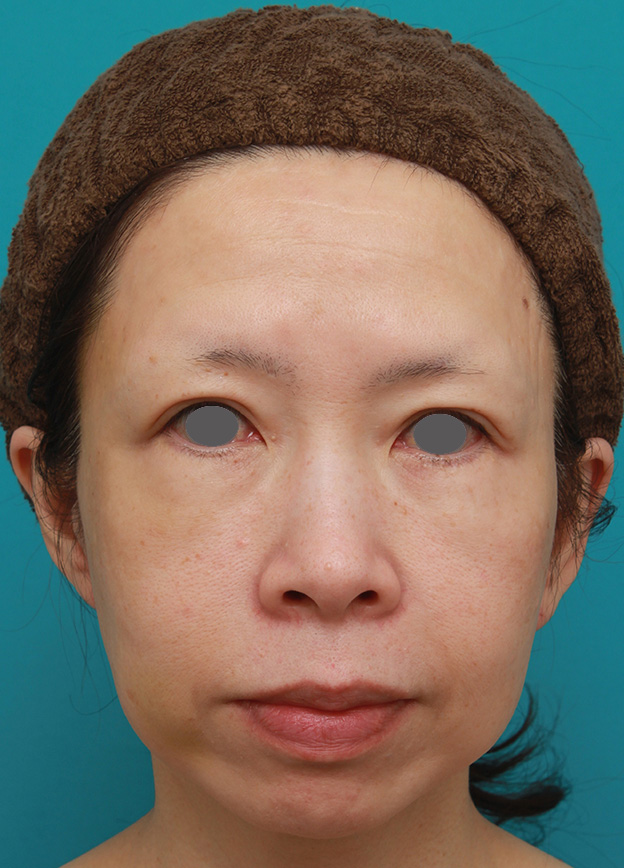 イタリアンリフト,イタリアンリフトで頬のたるみをリフトアップした50代女性の症例写真の術前術後画像,施術前,mainpic_italian07a.jpg