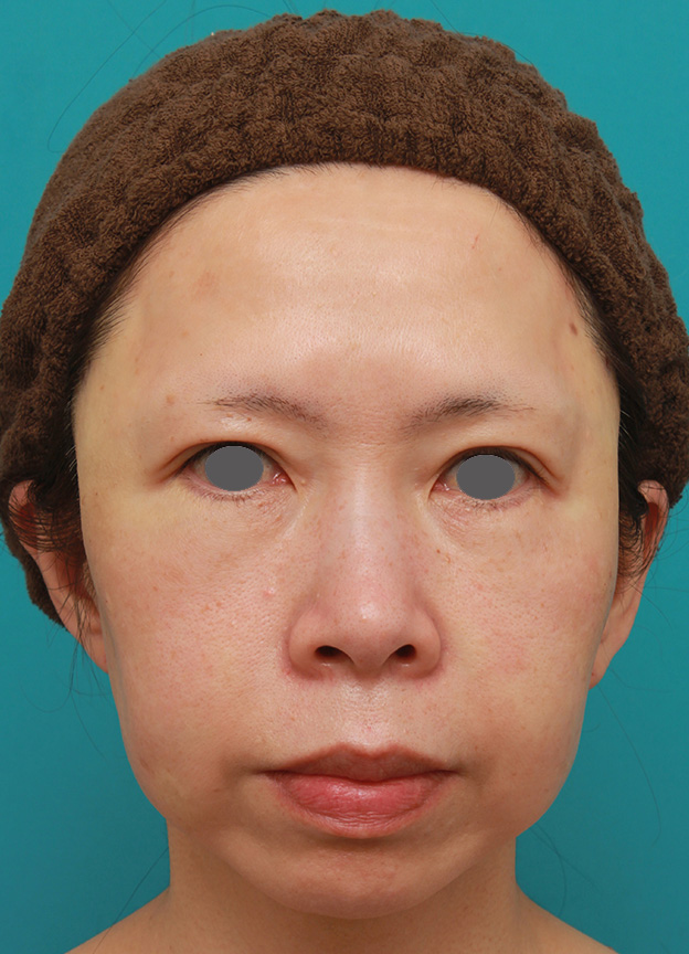イタリアンリフト,イタリアンリフトで頬のたるみをリフトアップした50代女性の症例写真の術前術後画像,施術直後,mainpic_italian07b.jpg