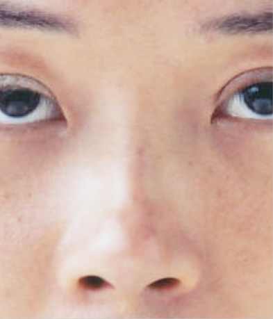 斜鼻修正（曲がった鼻をまっすぐに）,斜鼻修正（曲がった鼻をまっすぐに）の症例写真,After,ba_shabi01_b.jpg