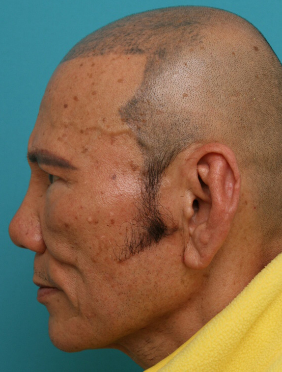 斜鼻修正（曲がった鼻をまっすぐに）,骨折して曲がって低くなった鼻にヒアルロン酸注射で修正した症例写真,After,ba_shabi04_b.jpg
