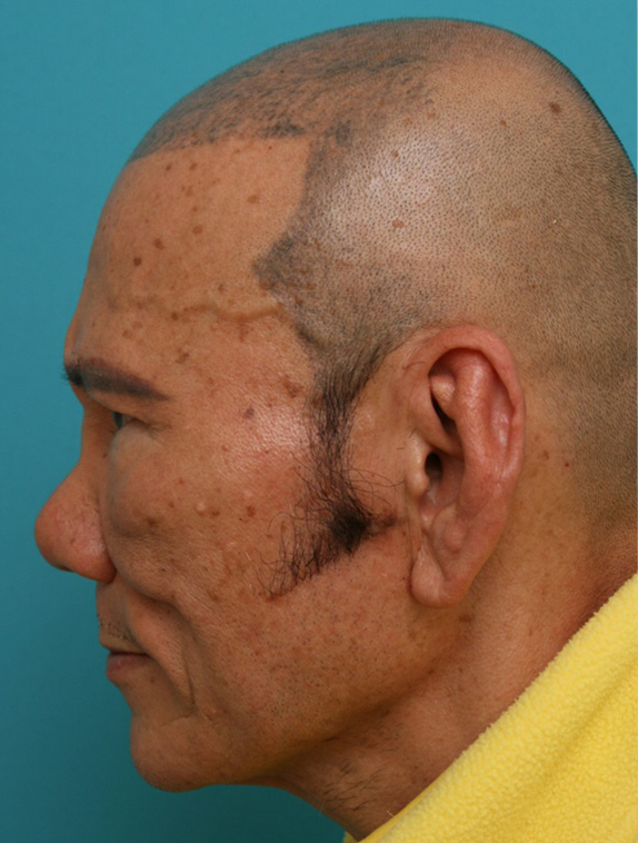 隆鼻注射（ヒアルロン酸注射）,骨折して曲がって低くなった鼻にヒアルロン酸注射で修正した症例写真,Before,ba_shabi04_b.jpg