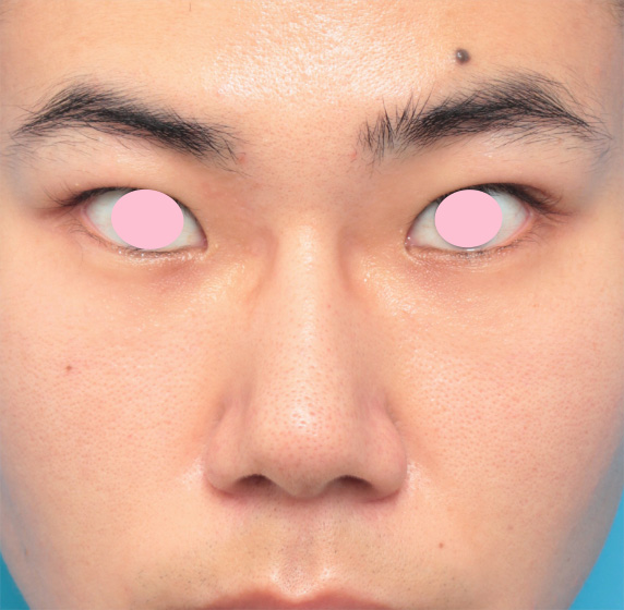 眉間プロテーゼ,眉間プロテーゼ+鼻プロテーゼ+鼻先耳介軟骨移植+小鼻縮小手術の症例写真,Before,ba_glabella01_b.jpg