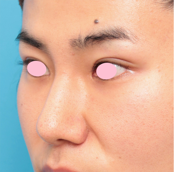 眉間プロテーゼ,眉間プロテーゼ+鼻プロテーゼ+鼻先耳介軟骨移植+小鼻縮小手術の症例写真,After（8ヶ月後）,ba_glabella02_b.jpg