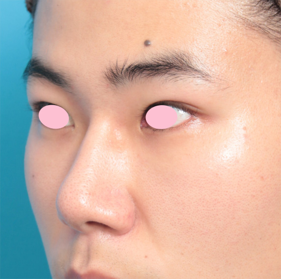眉間プロテーゼ,眉間プロテーゼ+鼻プロテーゼ+鼻先耳介軟骨移植+小鼻縮小手術の症例写真,Before,ba_glabella02_b.jpg