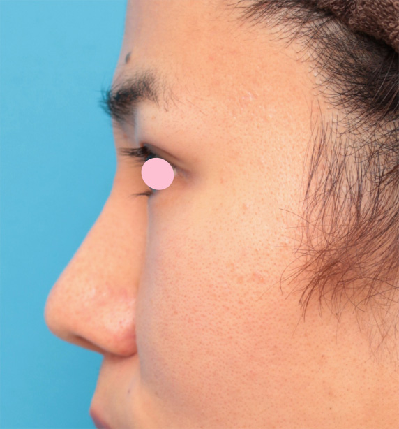 眉間プロテーゼ,眉間プロテーゼ+鼻プロテーゼ+鼻先耳介軟骨移植+小鼻縮小手術の症例写真,After（8ヶ月後）,ba_glabella03_b.jpg