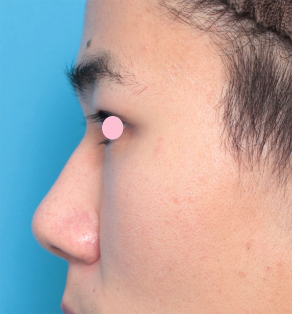 鼻翼縮小（小鼻縮小）,眉間プロテーゼ+鼻プロテーゼ+鼻先耳介軟骨移植+小鼻縮小手術の症例写真,Before,ba_glabella03_b.jpg