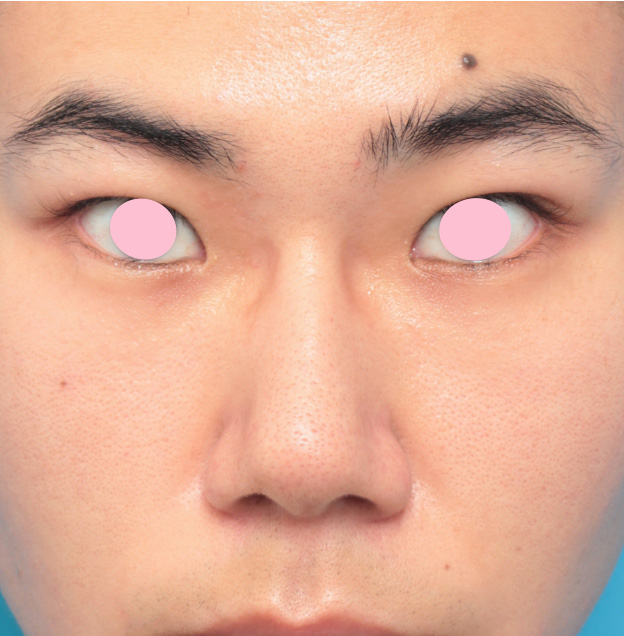 眉間プロテーゼ,眉間プロテーゼ+鼻プロテーゼ+鼻先耳介軟骨移植+小鼻縮小手術の症例写真,手術前,mainpic_glabella01a.jpg