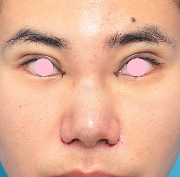 眉間プロテーゼ,眉間プロテーゼ+鼻プロテーゼ+鼻先耳介軟骨移植+小鼻縮小手術の症例写真,手術直後,mainpic_glabella01b.jpg