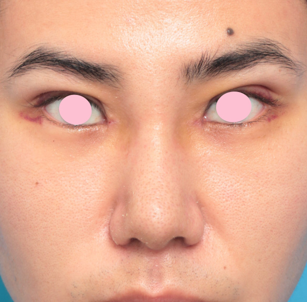 眉間プロテーゼ,眉間プロテーゼ+鼻プロテーゼ+鼻先耳介軟骨移植+小鼻縮小手術の症例写真,1週間後,mainpic_glabella01c.jpg