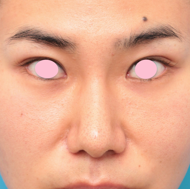 眉間プロテーゼ,眉間プロテーゼ+鼻プロテーゼ+鼻先耳介軟骨移植+小鼻縮小手術の症例写真,8ヶ月後,mainpic_glabella01d.jpg