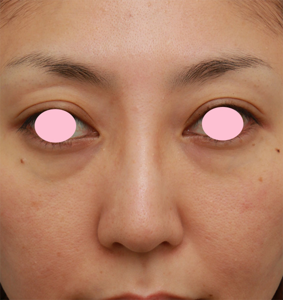 眉間プロテーゼ,眉間から鼻根部、鼻背にかけてシリコンプロテーゼを入れて立体的な顔立ちにした症例写真,After（4ヶ月後）,ba_glabella05_b.jpg