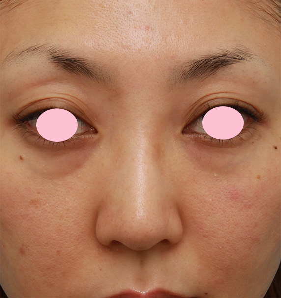 眉間プロテーゼ,眉間から鼻根部、鼻背にかけてシリコンプロテーゼを入れて立体的な顔立ちにした症例写真,Before,ba_glabella05_b.jpg