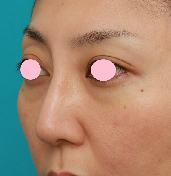 隆鼻術（シリコンプロテーゼ）,眉間から鼻根部、鼻背にかけてシリコンプロテーゼを入れて立体的な顔立ちにした症例写真,After（4ヶ月後）,ba_glabella06_b.jpg