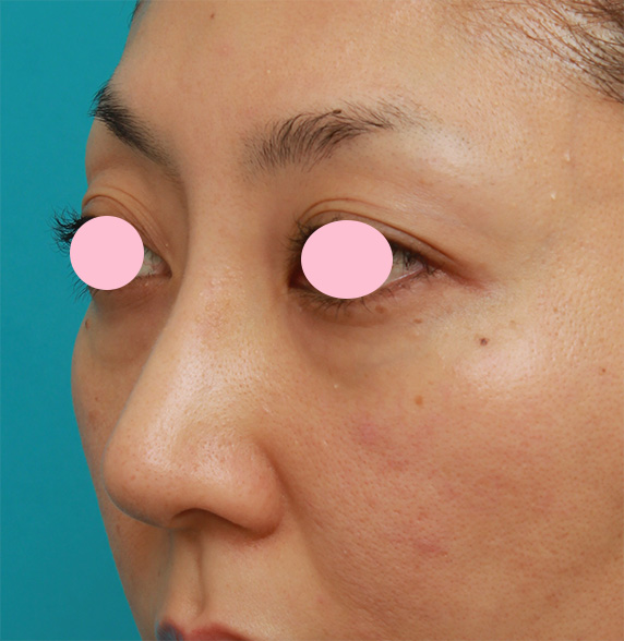 眉間プロテーゼ,眉間から鼻根部、鼻背にかけてシリコンプロテーゼを入れて立体的な顔立ちにした症例写真,Before,ba_glabella06_b.jpg