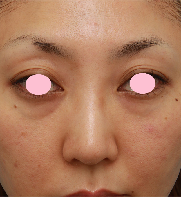 眉間プロテーゼ,眉間から鼻根部、鼻背にかけてシリコンプロテーゼを入れて立体的な顔立ちにした症例写真,手術前,mainpic_glabella02a.jpg