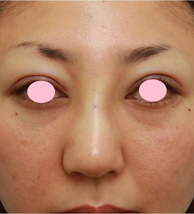眉間プロテーゼ,眉間から鼻根部、鼻背にかけてシリコンプロテーゼを入れて立体的な顔立ちにした症例写真,手術直後,mainpic_glabella02b.jpg