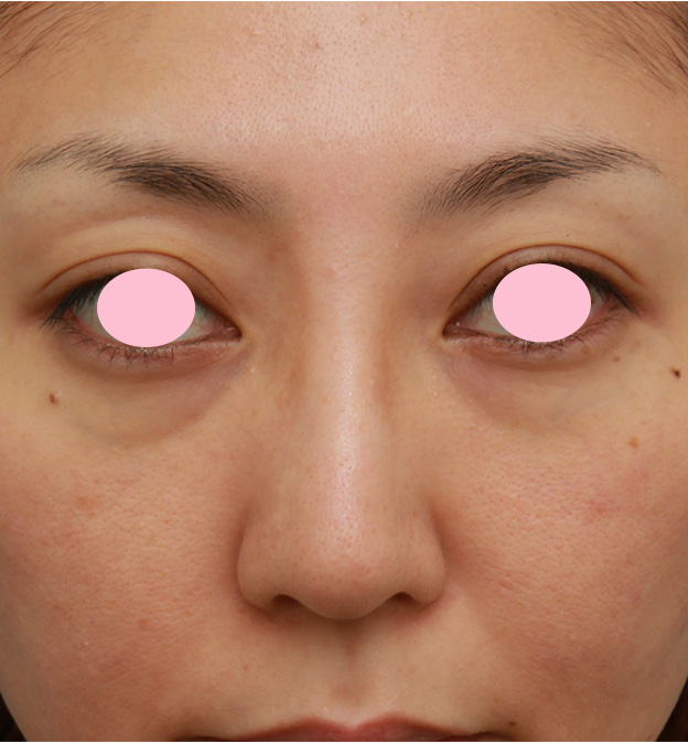 隆鼻術（シリコンプロテーゼ）,眉間から鼻根部、鼻背にかけてシリコンプロテーゼを入れて立体的な顔立ちにした症例写真,4ヶ月後,mainpic_glabella02e.jpg