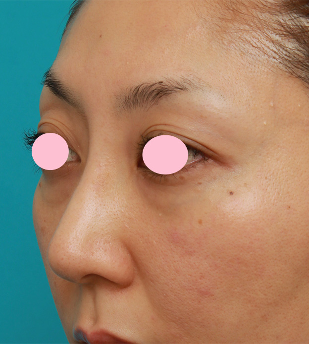 眉間プロテーゼ,眉間から鼻根部、鼻背にかけてシリコンプロテーゼを入れて立体的な顔立ちにした症例写真,手術前,mainpic_glabella02f.jpg