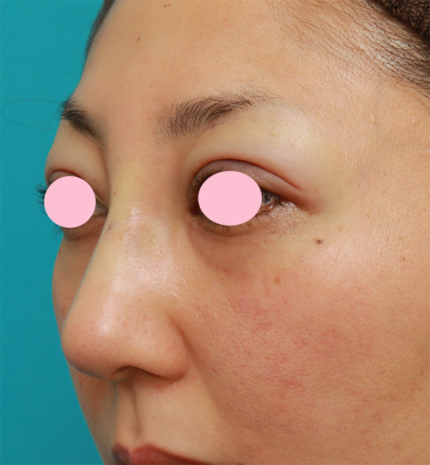 隆鼻術（シリコンプロテーゼ）,眉間から鼻根部、鼻背にかけてシリコンプロテーゼを入れて立体的な顔立ちにした症例写真,手術直後,mainpic_glabella02g.jpg