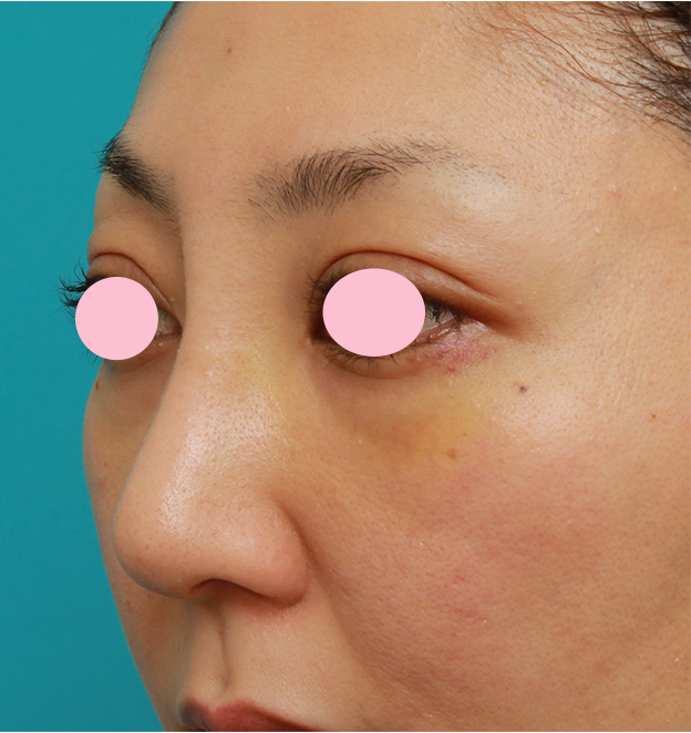 隆鼻術（シリコンプロテーゼ）,眉間から鼻根部、鼻背にかけてシリコンプロテーゼを入れて立体的な顔立ちにした症例写真,1週間後,mainpic_glabella02h.jpg