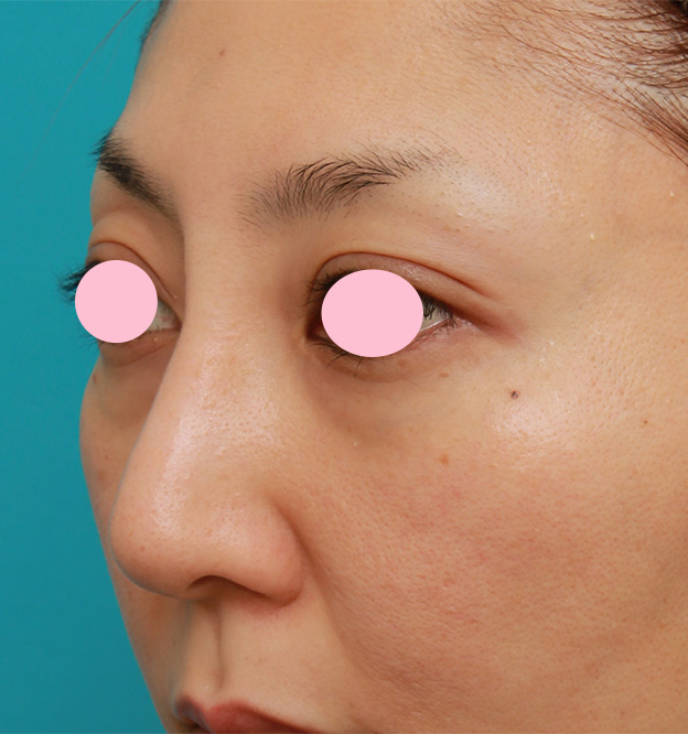 隆鼻術（シリコンプロテーゼ）,眉間から鼻根部、鼻背にかけてシリコンプロテーゼを入れて立体的な顔立ちにした症例写真,1ヶ月後,mainpic_glabella02i.jpg