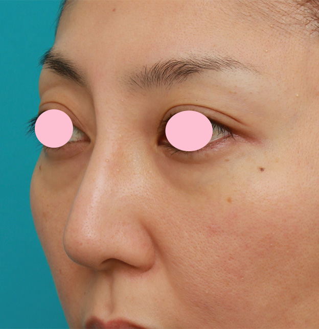 眉間プロテーゼ,眉間から鼻根部、鼻背にかけてシリコンプロテーゼを入れて立体的な顔立ちにした症例写真,4ヶ月後,mainpic_glabella02j.jpg