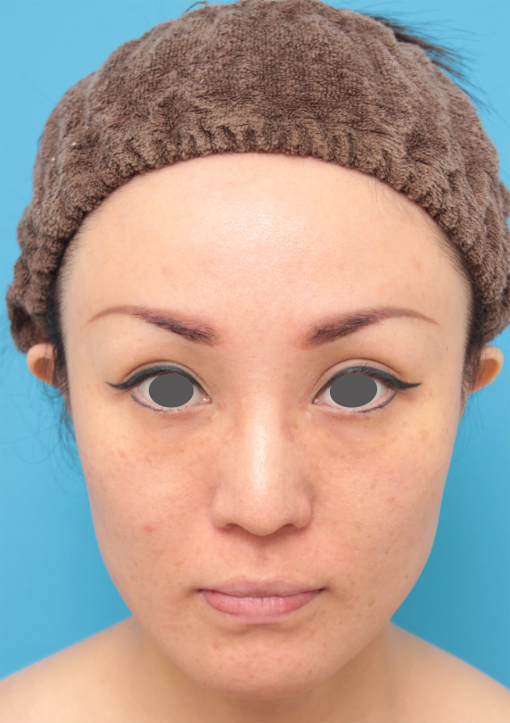 ボツリヌストキシン注射（エラ、プチ小顔術）,イタリアンリフトファイン+ボツリヌストキシン注射（エラ、プチ小顔術）で肌の張りを出して、顔を引き締めて小顔にした20代後半女性の症例写真の術前術後画像,After（6ヶ月後）,ba_italianlift_fine10_b.jpg