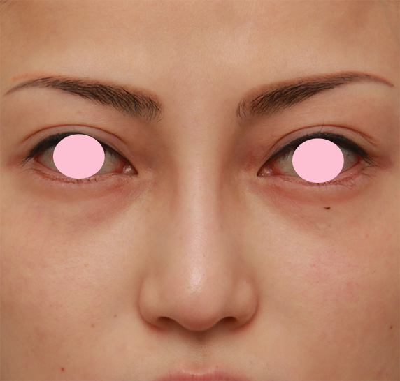 隆鼻術（シリコンプロテーゼ）,眉間から鼻にかけてシリコンプロテーゼを入れ、かなり高くし、鼻筋を通した症例写真の術前術後画像,After（4ヶ月後）,ba_glabella07_b.jpg