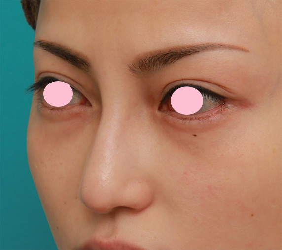 眉間プロテーゼ,眉間から鼻にかけてシリコンプロテーゼを入れ、かなり高くし、鼻筋を通した症例写真の術前術後画像,After（4ヶ月後）,ba_glabella08_b.jpg
