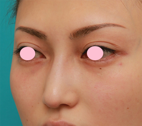 眉間プロテーゼ,眉間から鼻にかけてシリコンプロテーゼを入れ、かなり高くし、鼻筋を通した症例写真の術前術後画像,Before,ba_glabella08_b.jpg