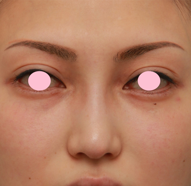 眉間プロテーゼ,眉間から鼻にかけてシリコンプロテーゼを入れ、かなり高くし、鼻筋を通した症例写真の術前術後画像,手術前,mainpic_glabella03a.jpg