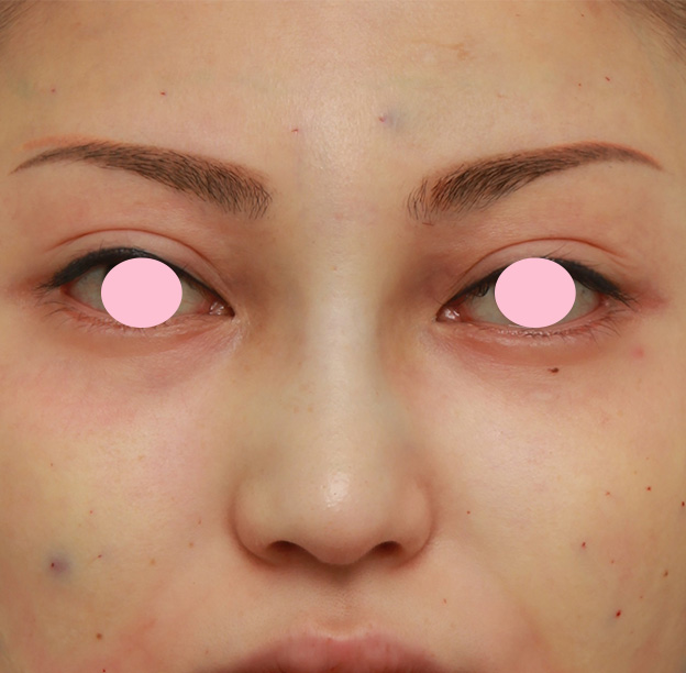 眉間プロテーゼ,眉間から鼻にかけてシリコンプロテーゼを入れ、かなり高くし、鼻筋を通した症例写真の術前術後画像,手術直後,mainpic_glabella03b.jpg