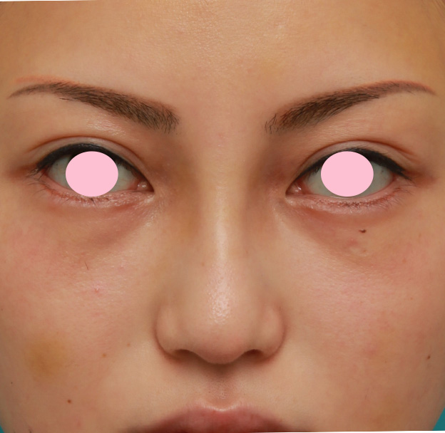 眉間プロテーゼ,眉間から鼻にかけてシリコンプロテーゼを入れ、かなり高くし、鼻筋を通した症例写真の術前術後画像,2週間後,mainpic_glabella03c.jpg