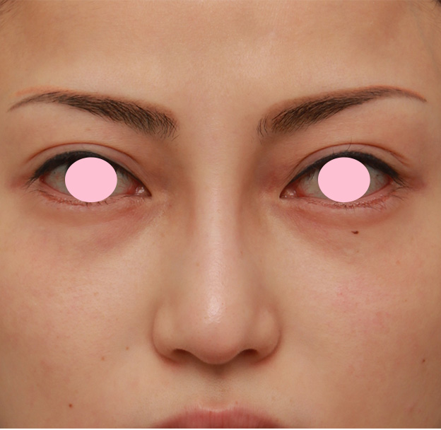 隆鼻術（シリコンプロテーゼ）,眉間から鼻にかけてシリコンプロテーゼを入れ、かなり高くし、鼻筋を通した症例写真の術前術後画像,4ヶ月後,mainpic_glabella03d.jpg