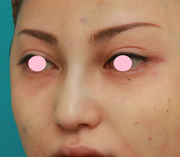 眉間プロテーゼ,眉間から鼻にかけてシリコンプロテーゼを入れ、かなり高くし、鼻筋を通した症例写真の術前術後画像,手術直後,mainpic_glabella03f.jpg