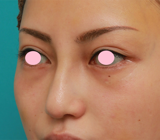 眉間プロテーゼ,眉間から鼻にかけてシリコンプロテーゼを入れ、かなり高くし、鼻筋を通した症例写真の術前術後画像,2週間後,mainpic_glabella03g.jpg