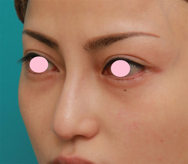 眉間プロテーゼ,眉間から鼻にかけてシリコンプロテーゼを入れ、かなり高くし、鼻筋を通した症例写真の術前術後画像,4ヶ月後,mainpic_glabella03h.jpg