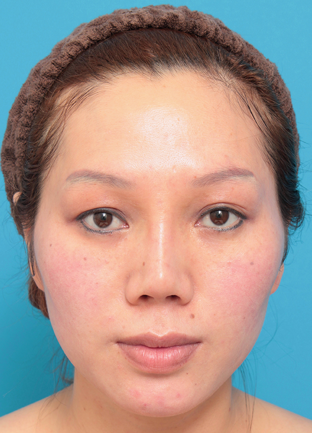 他院で受けた手術の修正（鼻）,L型シリコンプロテーゼをI型に入れ替え、耳介軟骨移植した症例写真,手術前,mainpic_prosthesis_removal01a.jpg