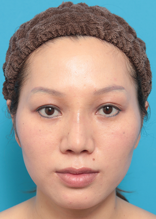 隆鼻術（シリコンプロテーゼ）,L型シリコンプロテーゼをI型に入れ替え、耳介軟骨移植した症例写真,1週間後,mainpic_prosthesis_removal01c.jpg