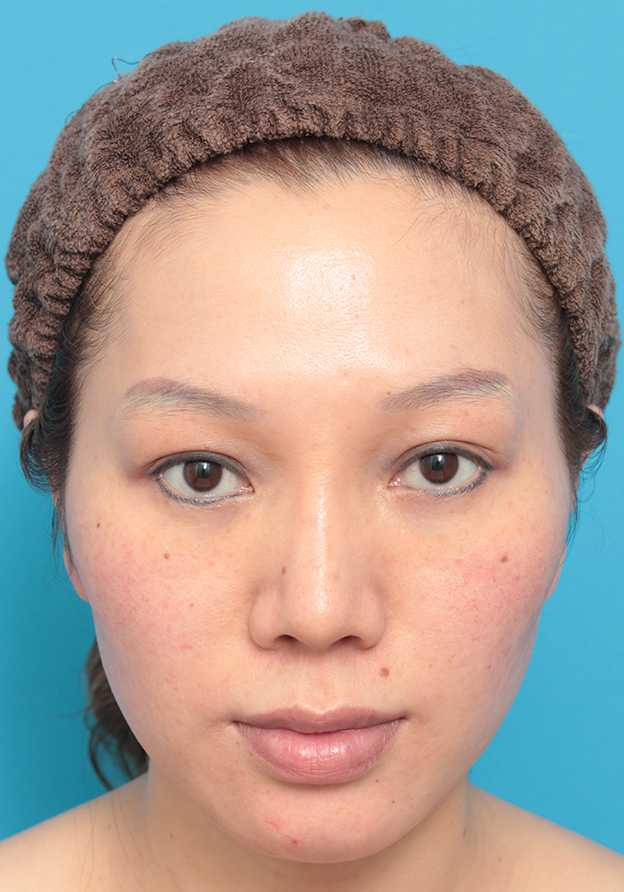隆鼻術（シリコンプロテーゼ）,L型シリコンプロテーゼをI型に入れ替え、耳介軟骨移植した症例写真,6ヶ月後,mainpic_prosthesis_removal01d.jpg