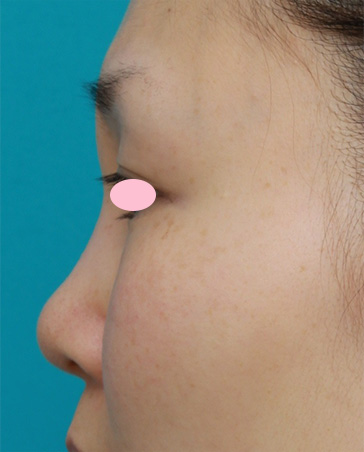 他院で受けた手術の修正（鼻）,鼻に注入されたアクアミドorアクアジェルorバイオアルカミドと思われる注入物を除去した症例,After（1ヶ月後）,ba_hanaaquamid05_b.jpg