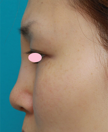 他院で受けた手術の修正（鼻）,鼻に注入されたアクアミドorアクアジェルorバイオアルカミドと思われる注入物を除去した症例,Before,ba_hanaaquamid05_b.jpg