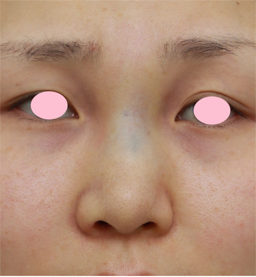 症例写真,鼻に注入されたアクアミドorアクアジェルorバイオアルカミドと思われる注入物を除去した症例,手術直後,mainpic_hanaaquamid03c.jpg