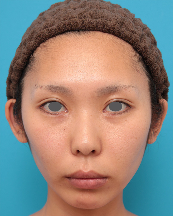 金の糸（ゴールデンリフト）,金の糸（ゴールデンリフト）で顔全体の肌の張りが出で、引き締まった印象になった20代女性の症例写真,After,ba_goldlift21_b.jpg