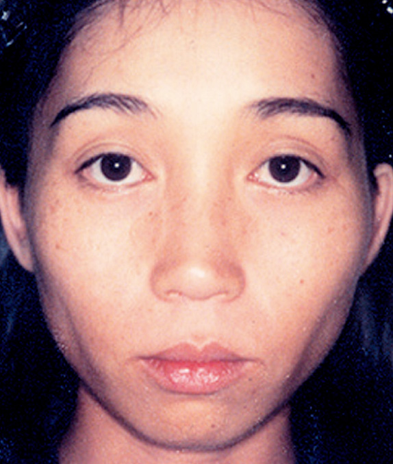 頬をふっくら・脂肪注入,顔面脂肪注入の症例写真,Before,ba_faceshibo_pic05_b.jpg