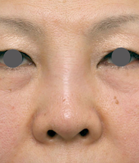 症例写真,他院で安価なヒアルロン酸を鼻に注射してアバターのようになった方の修正症例写真,注射前,mainpic_hyaluronjyokyo_01a.jpg