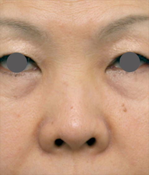 症例写真,他院で安価なヒアルロン酸を鼻に注射してアバターのようになった方の修正症例写真,ヒアルロニダーゼ注射後1週間,mainpic_hyaluronjyokyo_01c.jpg