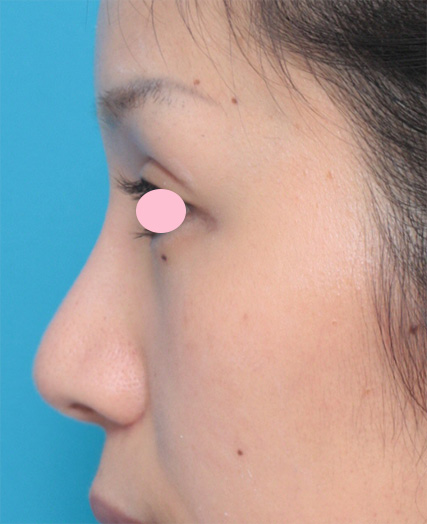 隆鼻術（シリコンプロテーゼ）,他院で入れた鼻のL型シリコンプロテーゼをI型に入れ替えて耳介軟骨移植と鼻翼縮小を行った症例写真,After（3ヶ月後）,ba_modify05_b.jpg