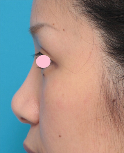 鼻のシリコンプロテーゼ抜き（除去）,他院で入れた鼻のL型シリコンプロテーゼをI型に入れ替えて耳介軟骨移植と鼻翼縮小を行った症例写真,Before,ba_modify05_b.jpg